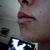 Juvederm Community Photo